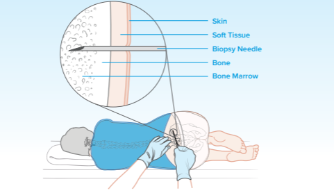 Bone Marrow Aspiration and Biopsy Bone Marrow Aspiration and Biopsy